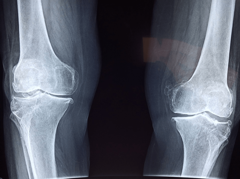 Human knee X-ray